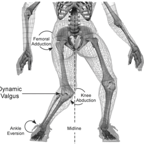 llustratie van voorste kruisband letsel door valgus-rotatietrauma.